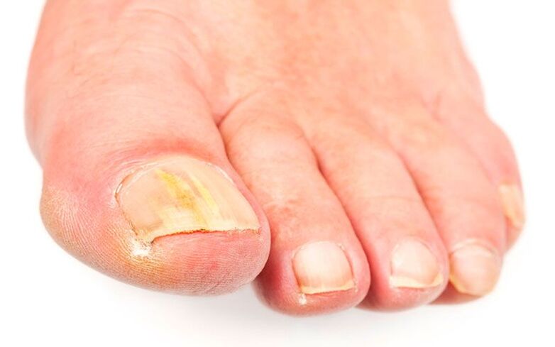 Les causes du champignon