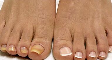 Méthodes de traitement des champignons de flotte