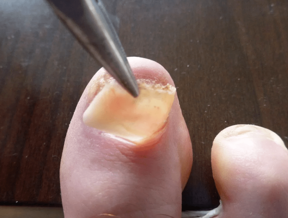 élimination de la plaque