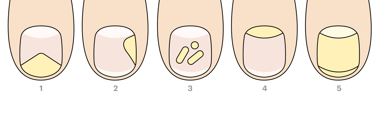 types de champignons des ongles des pieds