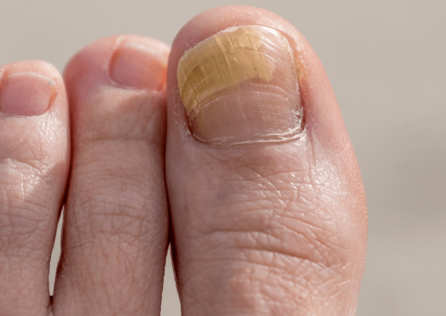 Champignon sur le gros ongle
