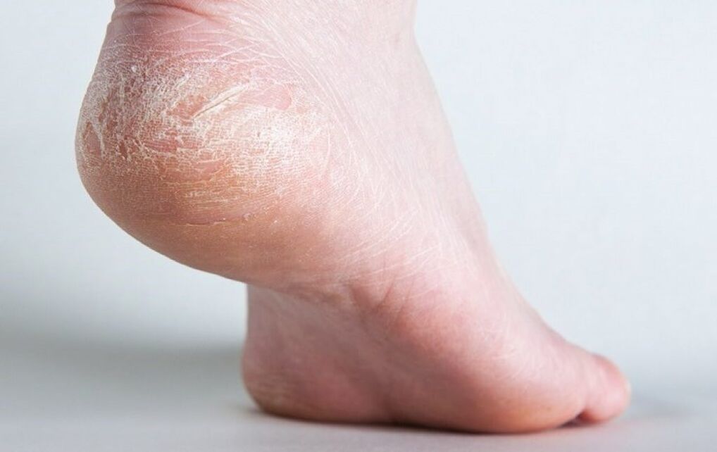 Champignon sur la peau des pieds